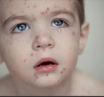 TRƯỜNG MẦM NON KỲ PHƯƠNG TUYÊN TRUYỀN VỀ BỆNH THỦY ĐẬU VÀ CÁCH PHÒNG BỆNH!